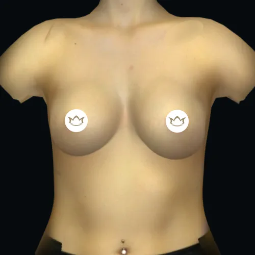 3D-Simulation der geplanten Brustvergrößerung