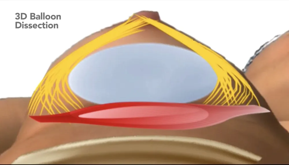 Skizze einer Brust, bei der das Implantat auf den Brustmuskel gesetzt ist.