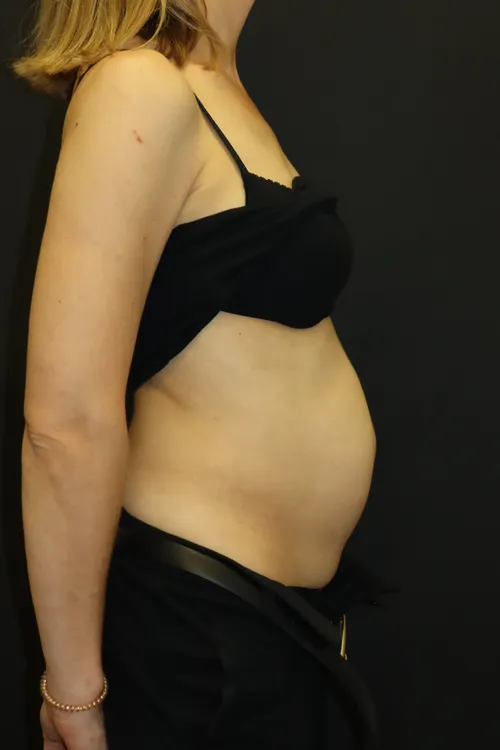 Seitlicher Befund vor der Operation: vorgewölbter Bauch bei Rektusdiastase